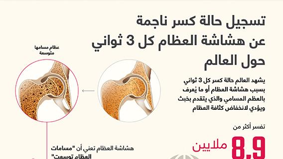 تسجيل حالة كسر ناجمة عن هشاشة العظام كل 3 ثواني حول العالم