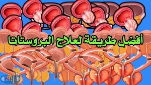 رحلة الشفاء: كيفية اختيار أفضل طريقة لعلاج البروستاتا